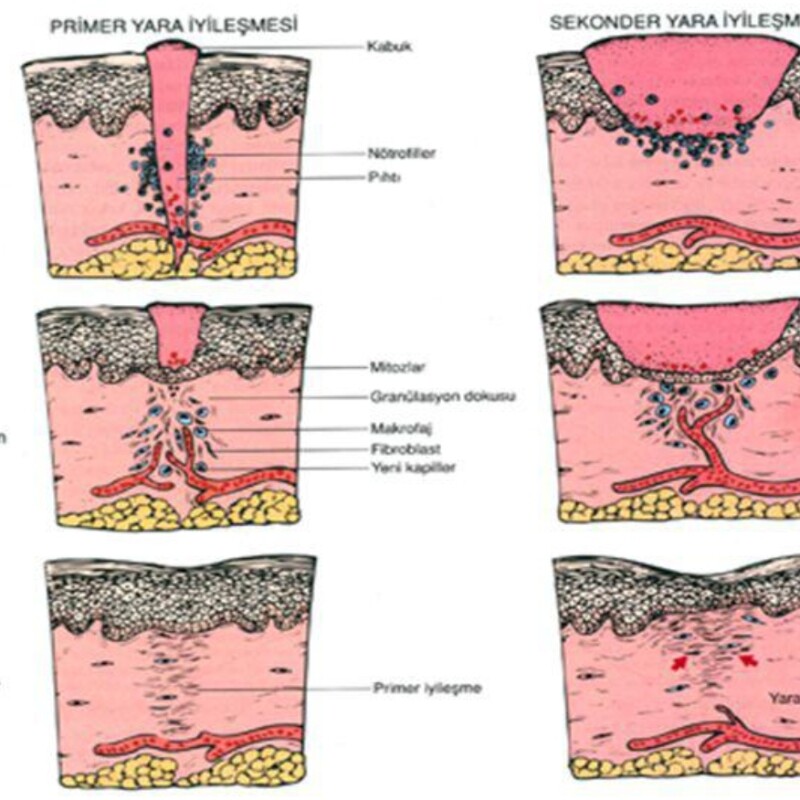İyileşmeyen Yaraların Tedavisi